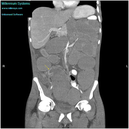 Figure 5: Coronal CT abdomen showing an abrupt beak-like transition point in the right iliac fossa with mural hyperenhancement (arrow) secondary to Crohn’s disease