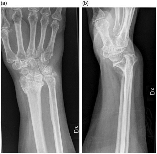 Figure 2. Preoperative CR of the same patient as in Figure 1. One year later, during conservative treatment, the distal radial fracture has healed in malunion and the patient is scheduled for corrective osteotomy. (a) AP view showing axial shortening. (b) Sagittal view showing severe volar tilt.