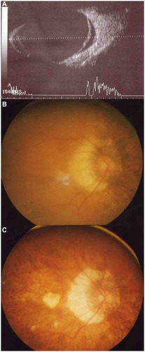 Figure 1 (A–C) Pictures of patient 3. Preoperative B-scan ultrasonography (A) shows that the detached retina is overhanging the posterior staphyloma. The retina of the posterior pole is detached preoperatively (B). After the second operation, the retina is completely reattached and shows appearance characteristic of high-myopic eye (C).