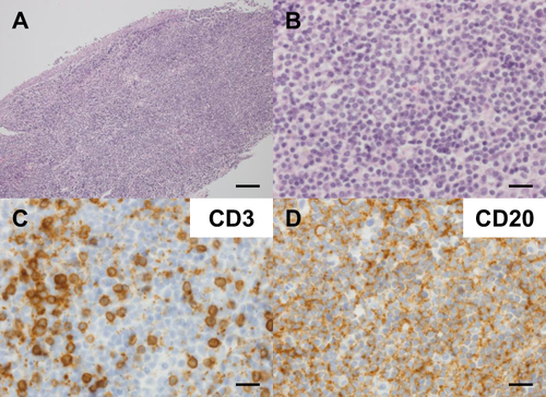 Figure 5 Histological images of conjunctival MALT lymphoma in the left eye in Case 14 (A and B) Hematoxylin and eosin staining. (A) Atypical lymphocytes were diffusely increased. Scale bar = 100 µm. (B) Chromatin was heavily stained and there was infiltration of small atypical lymphocytes with swollen nuclei. Scale bar = 20 µm. (C and D) Immunohistochemical staining for (C) CD3 and (D) CD20. Scale bar = 20 µm.