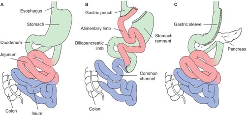 Figure 1 Schematic illustration of the preoperative (A) and postoperative anatomy of the gastrointestinal tract after a Roux-en-Y gastric bypass (B), and sleeve gastrectomy (C).