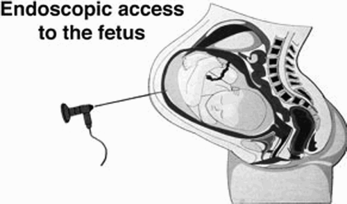 Figure 1. Minimally invasive access to the fetus. (Reprinted with permission from M. Harrison, http://www.fetus.ucsf.edu/)