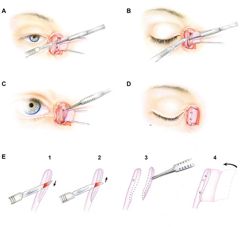 Figure 1. A-E: The surgical steps of the modified external dacryocystorhinostomy technique. A-B, opening of the lacrimal sac by a vertical cut in the sagittal plane medially of the common canalicular duct. C, excision of the medial part of the lacrimal sac. D, the remaining part of the anterior lacrimal wall is similarly connected to the U-shaped nasal mucosa flap. E, summary of the steps used in the modified external DCR technique described in this paper.