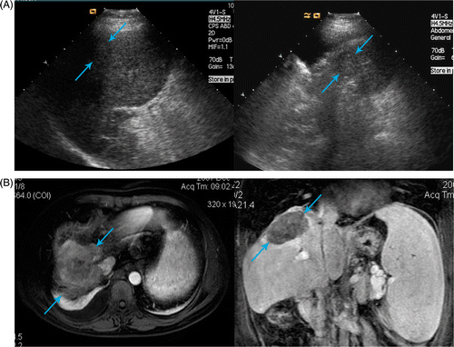 Figure 3. Hepatocellular carcinoma of a 45-year-old man. (A) The lesion (arrowhead) near the diaphragmatic dome and too difficult to be seen with US (left). After 1500 mL artificial pleural effusion, the lesion (arrowhead) was seen clearly (right). (B) One month after ablation, MRI scans show the lesion (arrowhead) was completely ablated in transverse plane (left) and coronal plane (right).