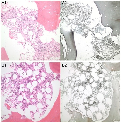 Figure 1. Bone marrow (BM) fibrosis and dysplasia of the de novo CML patient before TKI treatment (A1 and A2). Fibrosis and dysplasia of bone BM have been healed due to the pharmacobiological effects of TKIs after 3 years of imatinib and 1 year of dasatinib treatment (B1 and B2).