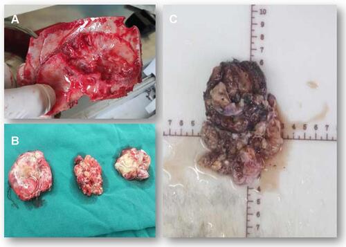 Figure 3 Surgical observations. The skull in the tumor area was partially protruding, the tumor invaded the skull, the adhesion of tumor tissue and skull was tight and the brain tissue of the right temporal lobe was compressed (A). The actual size of the tumor was 5.6 × 7.5 × 10.1 cm, and the texture was soft and gelatinous (B and C).