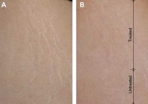 Figure 1. Clinical improvement of the striae alba after two sessions with the ablative 10 600-nm carbon dioxide fractional laser system: (A) before and (B) after the treatment. The laser therapy delivered was confined to the upper two-thirds of the lesion.