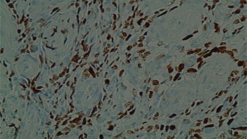 Figure 2. Histopathological examination showing atypical spindle cell Proliferations with slit like vascular Spaces, lymphoplasmacytic infiltrate and extravasated red blood cells.