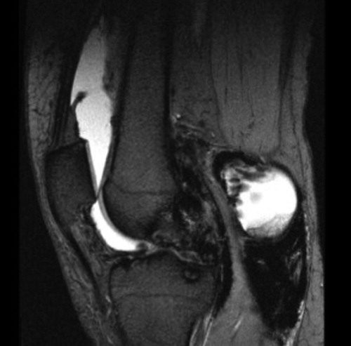 Figure 2. Gradient-echo-based MRI image from a patient with recurrent t-GCT (left knee). There was very low signal intensity corresponding to hemosiderin depositions, particularly in the posterior compartment of the joint and in the popliteal fossa. There was also osseous destruction.