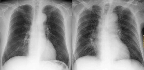 Figure 3. Adverse events caused by gilteritinib. Chest X-ray at the time of differentiation syndrome showed bilateral infiltrates and an enlarged cardiac silhouette (right panel). Left panel shows a chest X-ray before the onset of differentiation syndrome.