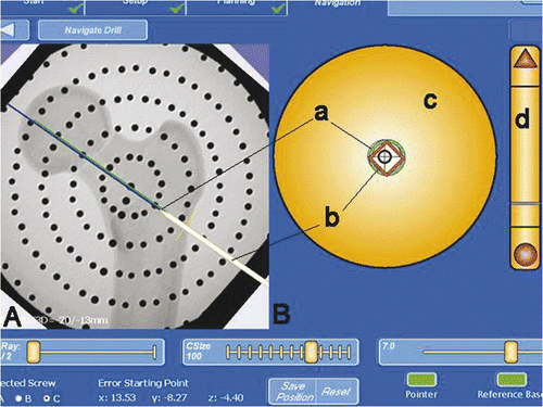 Figure 7. (A) Visualization of the image guided freehand navigation of the guide wire on the planned trajectory. (B) Display of two crosshair-like vectors for orientation of the navigation tool. The green circle (a) represents the position of the guide wire tip, and the red diamond (b) represents the position of a point on the guide wire axis. (c) is the crosshair-like representation of the online distance and direction from the guide wire tip to the axis of the planned trajectory (the diamond and circle in the center mean that the tool is aligned). (d) is a representation of the depth of the guide wire in relation to the lateral cortical bone.