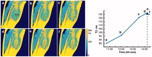 Figure 2. Sagittal T2 maps of one slice of the treatment region of patient 1. (a) Demonstrates the tissue before sonication treatment. (b–e) demonstrate increased T2 value over the course of the treatment duration—4 h. (f) Shows the T2 value approximately 20 min after treatment has ended. 2(right) is a quantification of this signal at the given ROI over time where the dotted arrowhead represents the final sonication treatment, just before point ‘e’. T2 maps were generated in MatLab.