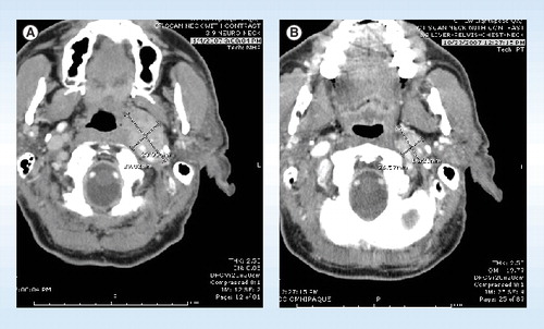 Figure 1. Computerized axial tomography scan images of a patient taking ZD 6474 as part of a randomized Phase II study showing a reduction in the size of affected neck nodes.(A) Shows the patient pre-treatment and (B) post-treatment, with significant shrinkage in the size of the tumor.