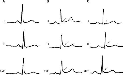 Figure 1 Representative ECG from our study population.