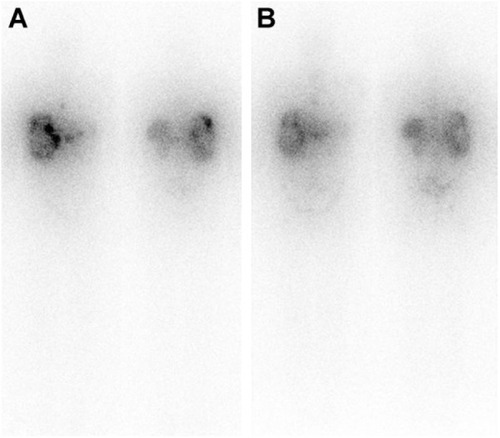 Figure 1 Patient with progressive GEP-NET treated at our institute.