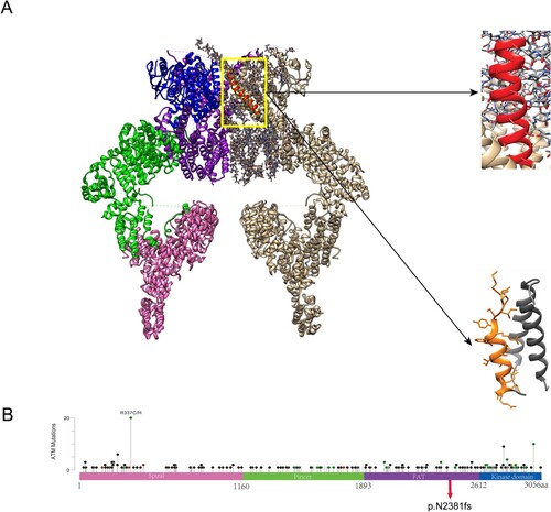 Figure 3. Mutations in ATM. (A) Protein structure of ATM dimer. On the left is the normal ATM protein structure, which serves as a control. The pink part represents the spiral region, the green part is the pincer region, the purple is the FAT structure region, and the blue is the kinase domain. On the right, the gray part is the unexpressed part after ATM mutation. The enlarged red part represents the unshifted region of a normal ATM protein. The enlarged yellow portion represents the amino acid sequence encoded by ATM after a code-shift due to deletion mutations. (B) The circle represents the mutation site, and the height represents the mutation frequency. ATM proteins are showing the spiral region, pincer region, FAT region, and kinase domain. Mutation p.N2381fs was found in the kinase domain of ATM.