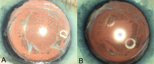 Figure 7 Silicone lens calcification in an eye with asteroid hyalosis before (A) and after (B) lens-debridement and vitrectomy.