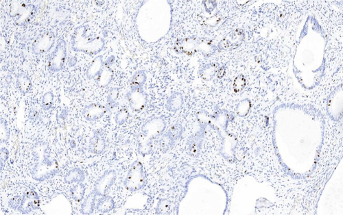 Figure S4 Immunohistochemical analysis of cell proliferative index Ki-67 nuclei expression in endometrial polyp (200×).
