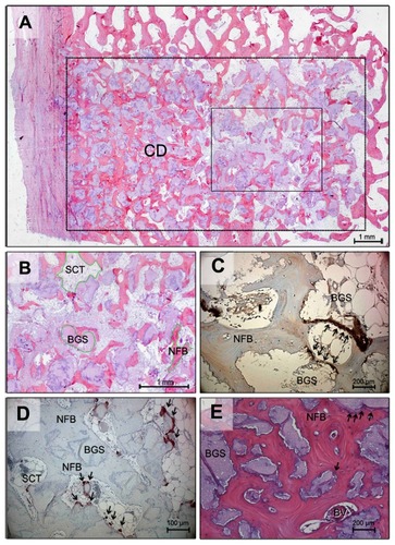 Figure 2 Histological section 12 weeks after implantation (HE, original magnification 25×): ROI is marked by a dotted line. Bony ingrowth occurs from the margins of the defect, especially from the periost to the center of the defect (A). Detail of Figure 1A: The fractions of tissue are marked (B). Histological section 26 weeks after implantation (osteocalcin staining, 200×): Osteoblast activity along the biomaterial and fibrous tissue is visualized (arrowheads). Cement lines within the newly formed bone also stain positively for osteocalcin (C). Histological section 26 weeks after implantation (TRAP staining, original magnification 100×): The granules of the biomaterial are mostly surrounded by new bone formation, but in contrast to fibrous tissue osteoclasts are still detectable (marked by arrowheads) (D). Histological section 26 weeks after implantation (HE, original magnification 100×): After a half-year, cellular activity is still apparent at the interface between bone and biomaterial, particularly near the newly formed blood vessels (E).Abbreviations: HE, hematoxylin and eosin; CD, center of the defect; NFB, newly formed bone; BGS, bone graft substitute; ROI, region of interest; SCT, soft connective tissue; BV, blood vessel; TRAP, tartrate-resistant acid phosphatase.
