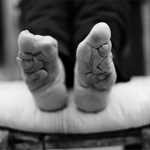 Figure 2. Aged, bound feet of Yange Jinge