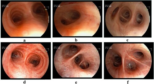 Figure 4. Bronchoscope imagings of patient 2 (a, b, c) and patient 3 (d, e, f). The typical bronchoscopy findings were hyperaemic tracheal and bronchial mucosa with oedema, with little thin white secretions in the segmental bronchi.