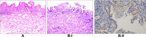 Figure 3 Stage II, surface epithelial cell infection. (A) Stage IIA, the degeneration of mucus surface epithelial cells: the amount of Helicobacter pylori (Hp) bacteria is significant, and the cytoplasm exhibits spiderweb-like vacuolar degeneration; the remaining cytoplasm surrounds the nucleus in a radial pattern, while a characteristic Hp-infection band can be observed under low magnification (hematoxylin and eosin staining [H&E], ×100). (B) Stage IIB, cell proliferation and transformation: I) A large amount of Hp adheres in the cytoplasm of the surface epithelial cells, resulting in massive proliferation and transformation of the cells in the depth of the gastric pit and the isthmus of the gastric gland, as well as in the proliferative zone in the upper part of the gland neck (H&E, ×200); II) the result for Hp is positive (EnVision method, ×400).