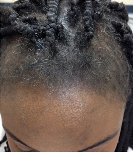 Figure 3 Marginal traction alopecia in patient with braids.