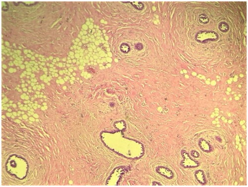 Figure 3. Low power view showing breast parenchyma displaying an increased number of ducts with a stromal proliferation (4× Magnification; Hematoxylin-Eosin staining).
