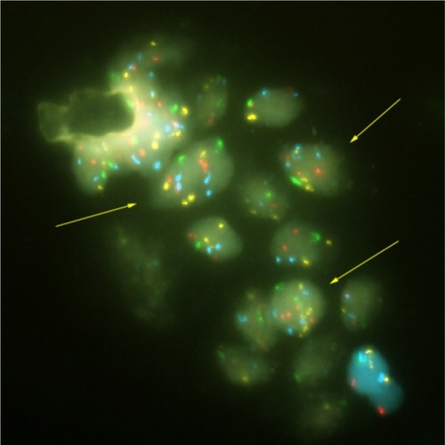 Figure 3 Prostatic cells released in the urine.