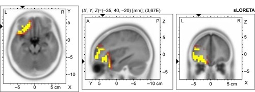 Figure 4 Voxel-wise statistical nonparametric map of sLORETA images in OCD patients with cognitive impairment (N=11) compared to healthy controls at the 0.05 significance level after correction for multiple comparisons.