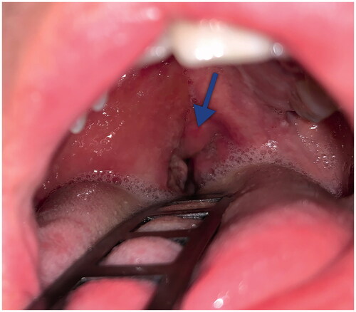 Figure 1. Clinical presentation of the patient in case 1. The peritonsillar area on the right side is swollen and edematous. The uvula (arrow) is deviated to the left side.