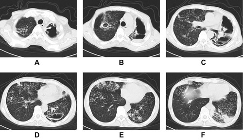 Figure 2 A 58-year-old male patient with MR-TB. CT scans showing whole-lung involvement with multiple proliferative lesions, multiple cavities (partially containing a gas-liquid interface), and disseminated lesions along the bronchi in both lungs (A–F).