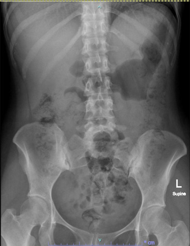 Figure 4 KUB films acquired 4 months after the final surgery.