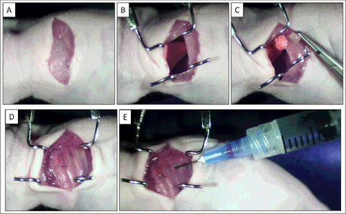 Figure 1. Establishment of osteosarcoma lung metastaswas PDOX model. A) A skin incision was made on the left chest wall. B) Chest muscles were separated and an intercostal incision in the chest wall was made, and the chest wall was opened. C) The left lung was taken up and tumor fragments were sewn into the lower lung with one suture. D) The incision in the chest wall was closed with a 6-0 surgical suture. E) An intrathoracic puncture was made to withdraw the remaining air in the chest cavity.