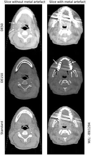 Figure 3. Example dual-energy images for one patient. The top row: 50 keV dual energy CBCT slices without (left) and with metal artifacts (right). Arrows point to areas with improved soft tissue contrast. Middle row: same as top row for 150 keV image. Arrows indicate reduced metal artifacts (black) and where new soft tissue information is uncovered (white). Bottom row: same as top row for standard clinical CBCT.