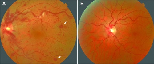 Figure 1 Color fundus photograph of the left eye of the patient with flare of multicentric Castleman’s disease.