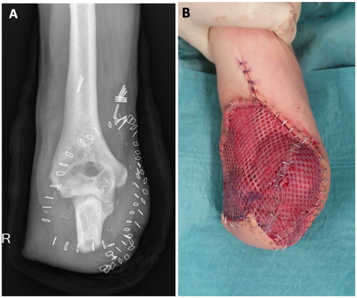 Figure 3. A demonstrates the final x-ray after serial debridement. After erradication of infection the ulna was shortened to a remaining stump of 7 centimeters, the radius was completely resected. B shows the immediate postoperative situs after a fasciocutaneous hatchet flap and meshed skin graft.
