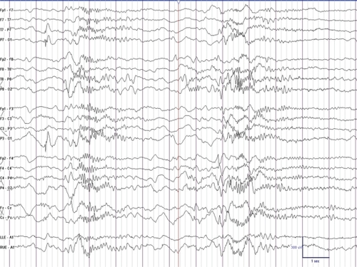 Figure 2 This is an EEG of a 8-year-old boy with Lennox-Gaustaut syndrome demonstrating paroxysmal fast activity during sleep. There were no observable clinical changes noted during the discharge.