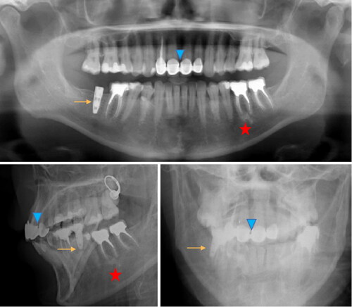 Figure 6. Antemortem radiological record (top) and 2 D postmortem face and profile images (bottom) with several strong markers: implant (arrow), anterior bridge (arrowhead), apical cementosis (star).