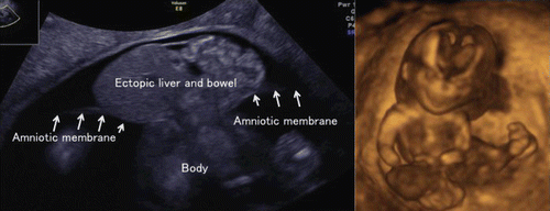 Figure 48.  Limb body-wall complex at 13 weeks of gestation. Left; 2D image. Note the ectopic liver and bowels are outside amniotic membrane. Right; 3D reconstructed image. Ectopic abdominal organs and abnormal position of lower limbs are well demonstrated.