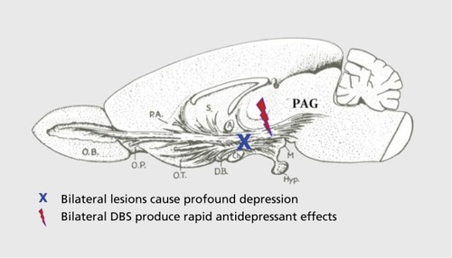 Figure 3. The first schematic representation of the medial forebrain bundle, a massive two-way neural pathway, coursing through the lateral hypothalamus, interconnecting the central regions of the midbrain with higher brain limbic regions, as first illustrated by LeGros ClarkCitation36 in 1938. Large bilateral damage as indicated by the blue X produces a profound amotivational dysphoric state where animals do not initially eat or drink or explore, while deep brain stimulation, as highlighted by the red “jolt” can produce sustained exploration and investigation of objects, with persistent sniffing, which proves to be highly rewarding (however, those behaviors do not reflect any behavior seen as animals are consuming rewards, but rather behavioral states that anticipate and seek rewards). The periaqueductal gray (PAG) of the midbrain is highlighted; it is the brain area with the highest concentration of emotional systems in the brain, with the dorsal PAG being the most aversive brain area as monitored with punishing effects (with concentrated RAGE, FEAR, and PANIC systems). Deep brain stimulation (DBS) of the dorsal PAG can produce a sustained decrease in the enthusiasm of the medial forebrain bundle, which is an affective model of depression. For a more comprehensive summary of the connectivities of the dopamine-enriched medial forebrain bundle, see Figure 4. Anatomical abbreviations from rostral to caudal: OB, olfactory bulbs; OP, olfactory peduncle; PA, paraolfactory area; OT, olfactory tract; S, septal area; DB, diagonal band of Broca; A, anterior commissure; Ch, optic chiasm; Hyp, hypophisis (pituitary gland); M, mammillary bodies.