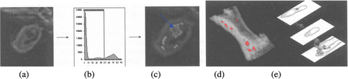 Figure 4. Axial section of the brachiocephalic artery image in control shown in panel (a) and after ‘artery injury’ induced mice ex vivo showing lipid rich necrotic core enhancement by iron oxide particles (arrow in c). Plaque components can be quantified using semi-automated segmentation techniques based on signal intensity histograms shown in panel (b). Segmentation allows quantification of individual vessel components and, in addition, (c) the segmented images can discriminate vessel damage shown with arrow in panel c. Combining slices, it can be reconstructed to show anatomical relationships of different components in 3D such as (demarcated necrotic cores in d). Wall details are visible in three different levels (e).