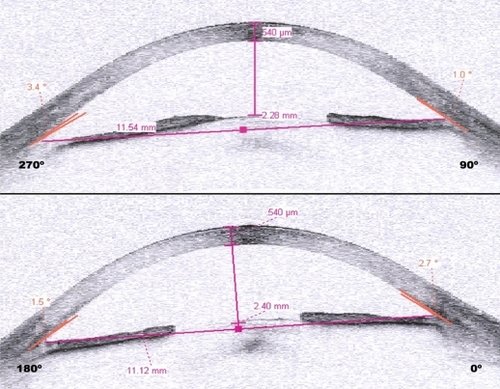Figure 1 Case 5. Anterior chamber image obtained by anterior segment optical coherence tomography prior to treatment. Notice the narrow but open angle.