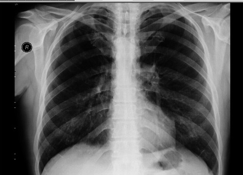 Figure 1 Bilateral hyperlucency is visible in this X-ray.