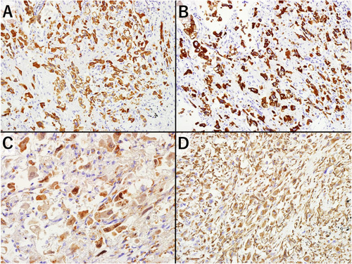 Figure 4 Immunohistochemical findings of the tumors. The malignant pleomorphic cells are positive for all stains. (A) AE1/AE3. (B) CAM5.2. (C) TTF-1/Napsin-A. (D) Vimentin.