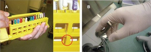 Figure 2 Examples of injured cases. A) Sharp instrument (a file) injury after treatment. The tip of a file is protruding from the instrument stand (red circle). B) Unexpected injury could occur during and after treatment. Left bur or scalar tip with hand pieces has a potential risk for injury.