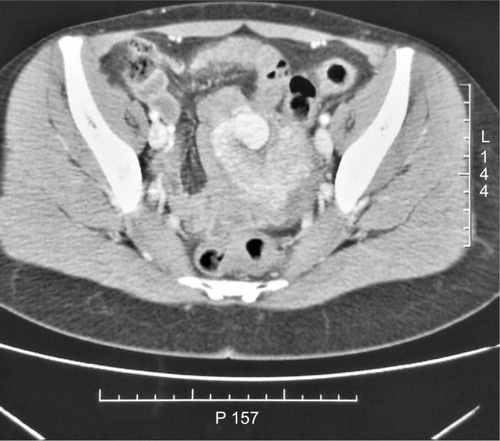 Figure 1 Axial CT image of presumed diagnosis of a uterine AVM in a 28-year-old patient.