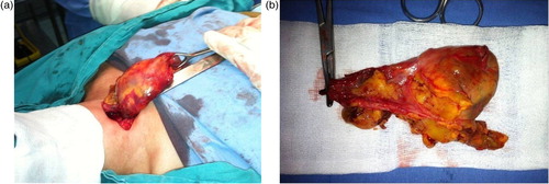Fig. 3 (a) Tumor removal through the cervical approach. (b) Tumor's aspect after a complete monoblock extirpation.