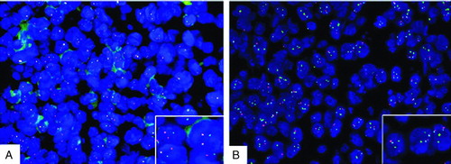 FIGURE 3  A break-apart probe showed that tumor cells have c-myc translocations. (A) Tricolor fusion probe for c-myc/IgH showed that tumor cells were negative for t(8;14), which (B) indicates that the partner of myc was probably IgL or some other gene.