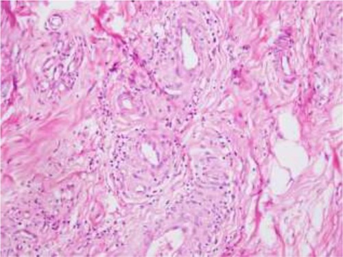 Figure 7 Small- and medium-sized vasculitis characterized by lymphocytic and neutrophilic infiltrate in wall of subcutaneous vessels obtained from sural nerve biopsy (hematoxylin-eosin; original magnification: ×200).